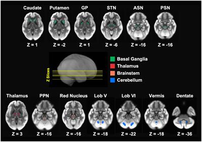 Free water imaging unravels unique patterns of longitudinal structural brain changes in Parkinson’s disease subtypes